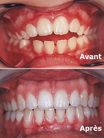 Orthodontie enfant avant et après activateur dentaire